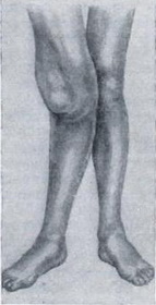 артропатия коленного сустава